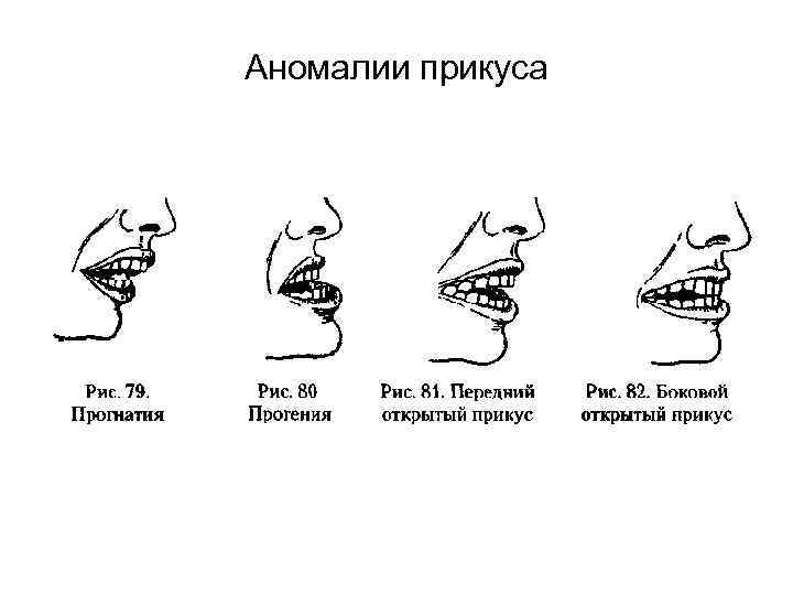 Аномалии прикуса 