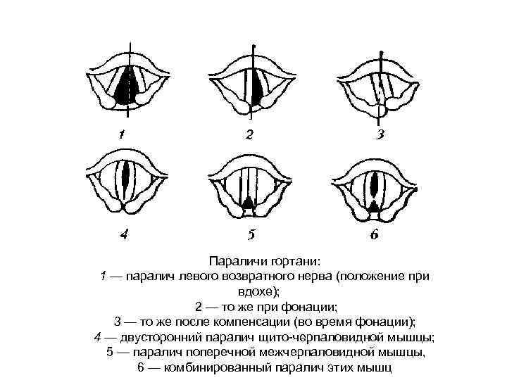 Параличи гортани: 1 — паралич левого возвратного нерва (положение при вдохе); 2 — то