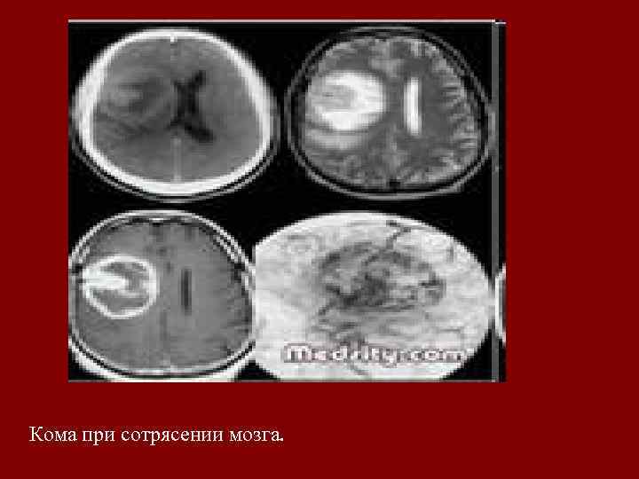 Кома при сотрясении мозга. 