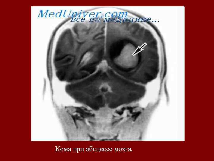 Кома при абсцессе мозга. 