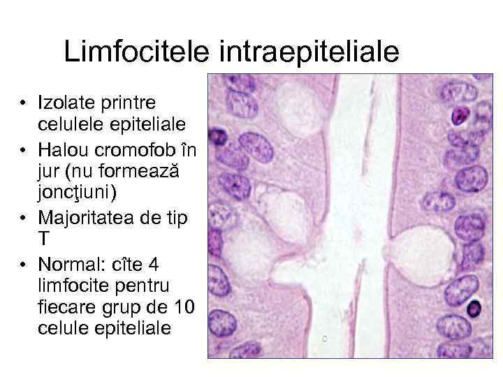 Limfocitele intraepiteliale • Izolate printre celulele epiteliale • Halou cromofob în jur (nu formează