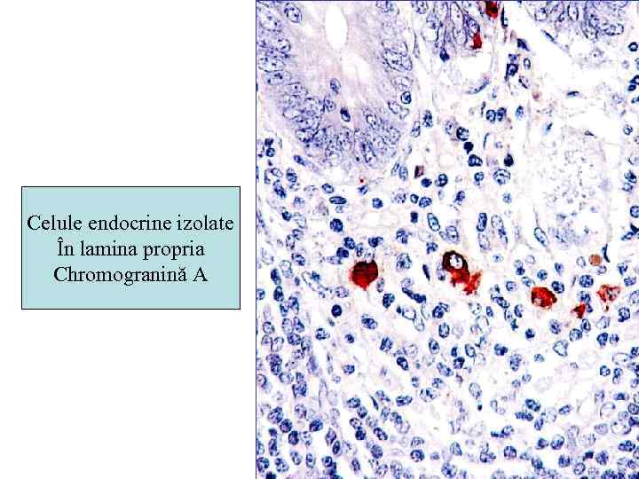 Celule endocrine izolate În lamina propria Chromogranină A 