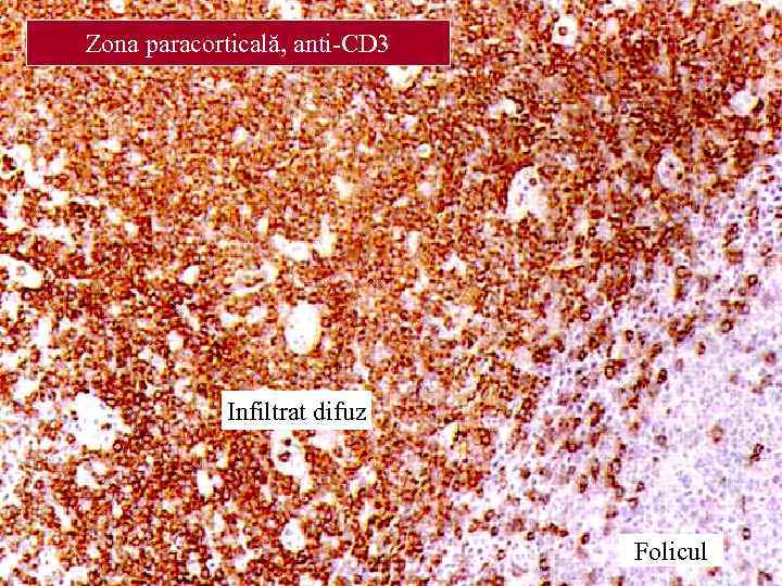 Zona paracorticală, anti-CD 3 Infiltrat difuz Folicul 