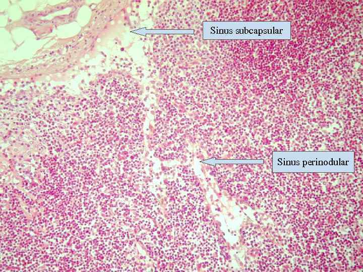 Sinus subcapsular Sinus perinodular 