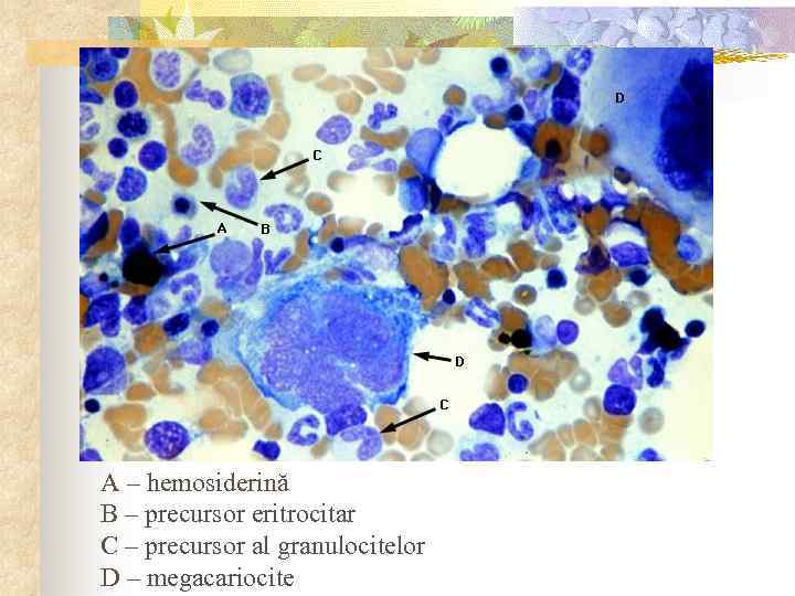 A – hemosiderină B – precursor eritrocitar C – precursor al granulocitelor D –