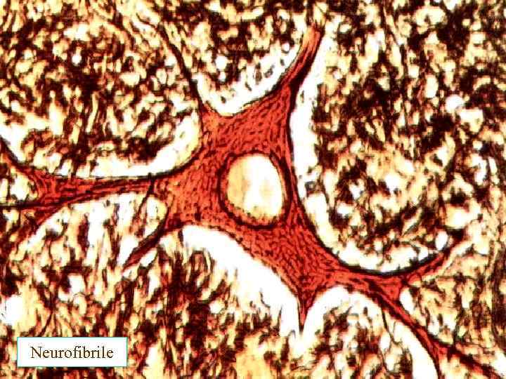 Neurofibrile 