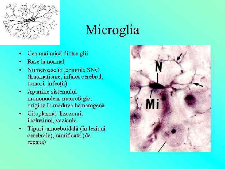 Microglia • Cea mai mică dintre glii • Rare la normal • Numeroase în