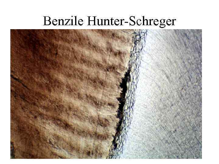 Benzile Hunter-Schreger 