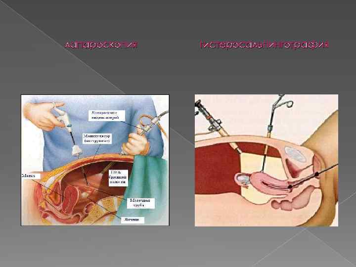 лапароскопия гистеросальпингография 