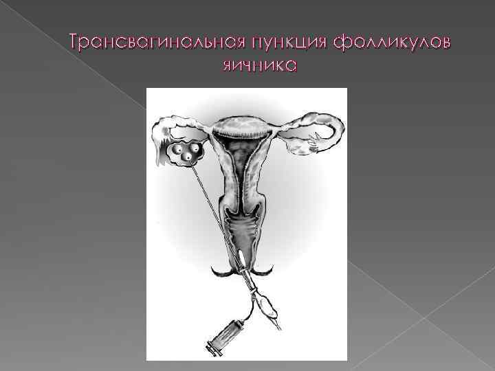 Трансвагинальная пункция фолликулов яичника 