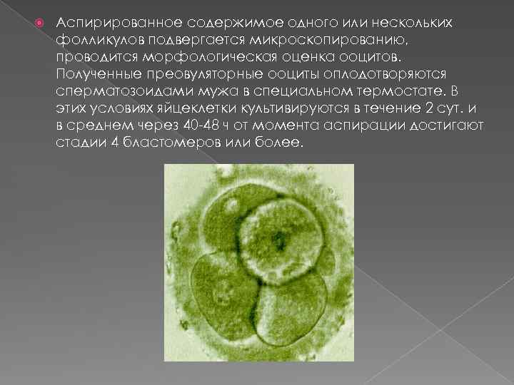  Аспирированное содержимое одного или нескольких фолликулов подвергается микроскопированию, проводится морфологическая оценка ооцитов. Полученные