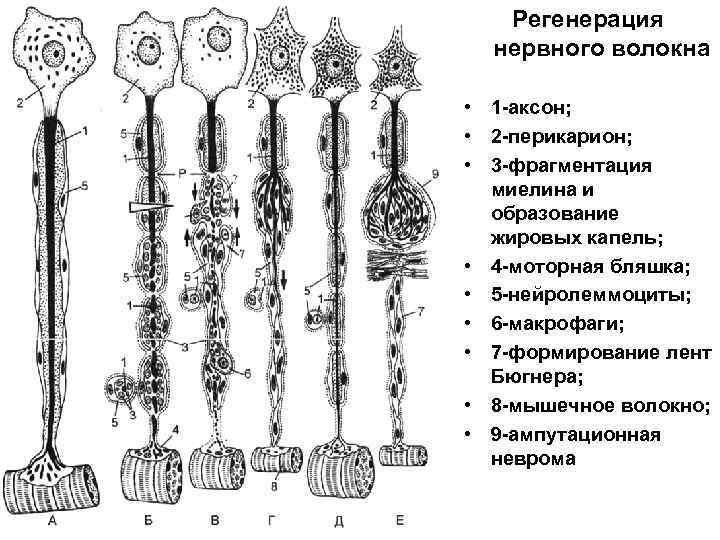 Регенерация нервного волокна • 1 -аксон; • 2 -перикарион; • 3 -фрагментация миелина и