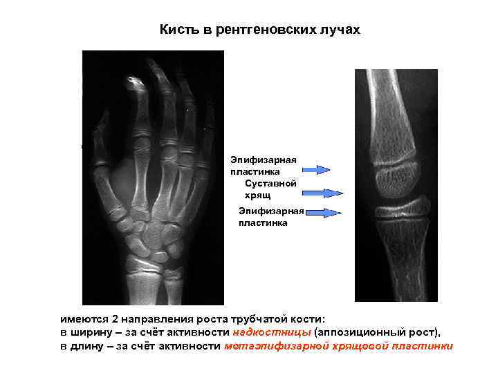 Кисть в рентгеновских лучах HAND X-RAY Cartilage Articular Plate Epiphyseal Эпифизарная пластинка Суставной хрящ