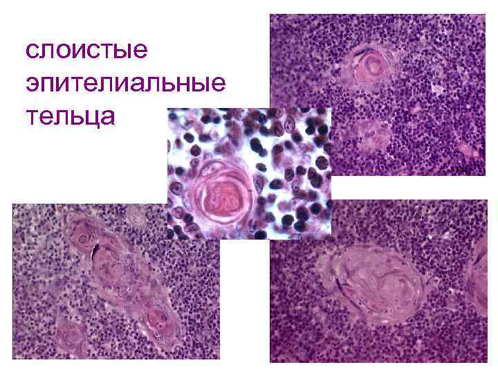 слоистые эпителиальные тельца 