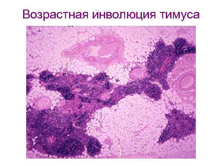 Возрастная инволюция тимуса 