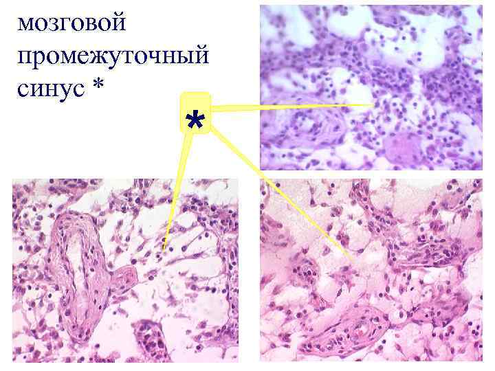 мозговой промежуточный синус * * 