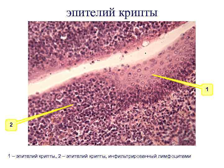 эпителий крипты 1 2 1 – эпителий крипты, 2 – эпителий крипты, инфильтрированный лимфоцитами