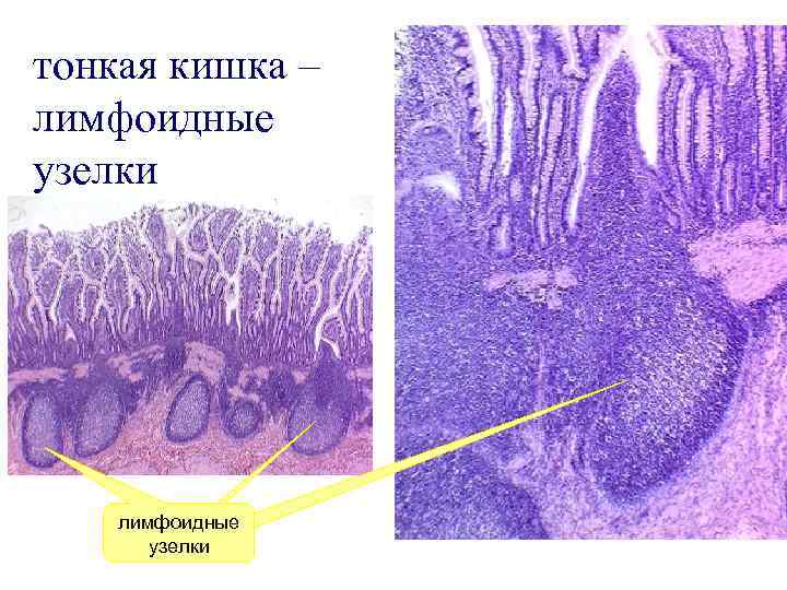 тонкая кишка – лимфоидные узелки 