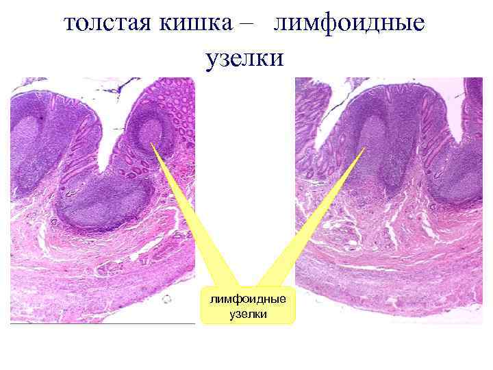 толстая кишка – лимфоидные узелки 