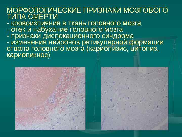 МОРФОЛОГИЧЕСКИЕ ПРИЗНАКИ МОЗГОВОГО ТИПА СМЕРТИ - кровоизлияния в ткань головного мозга - отек и