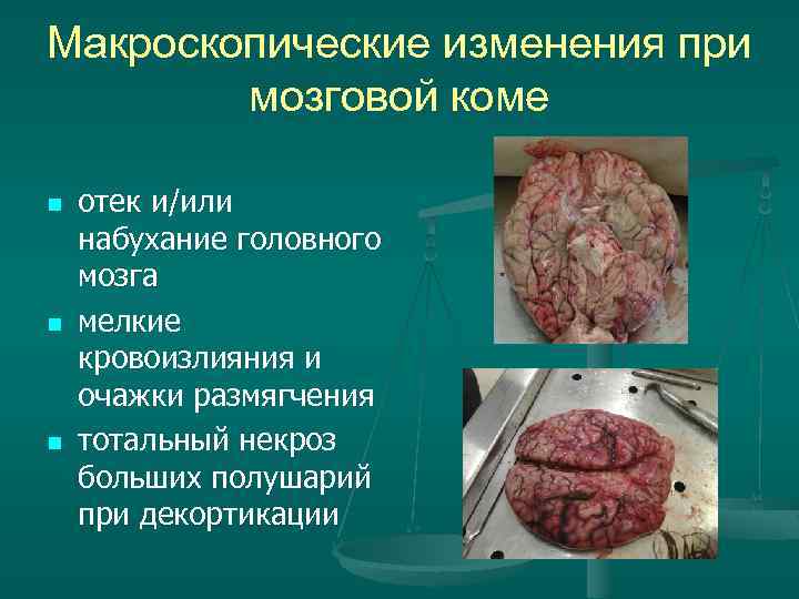 Макроскопические изменения при мозговой коме n n n отек и/или набухание головного мозга мелкие