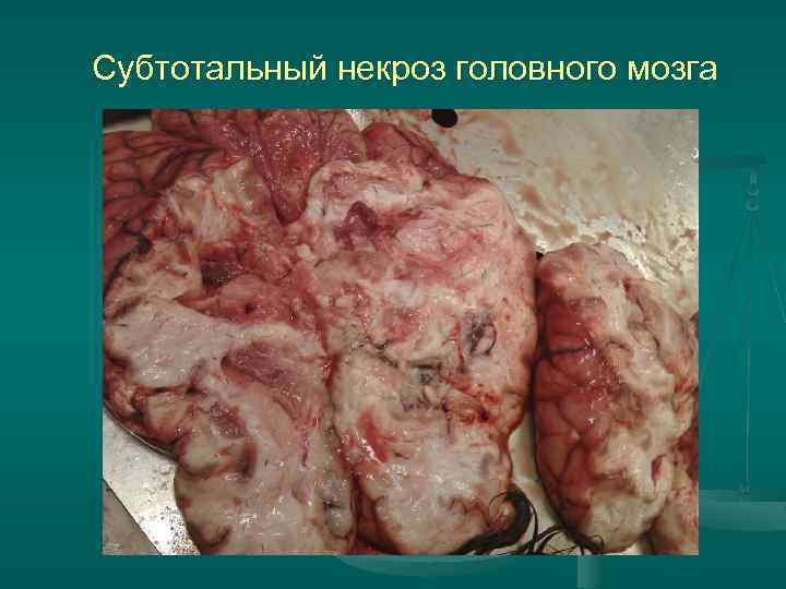 Субтотальный некроз головного мозга 