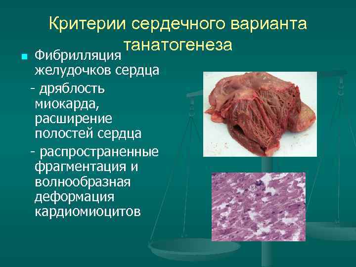Критерии сердечного варианта танатогенеза Фибрилляция желудочков сердца - дряблость миокарда, расширение полостей сердца -
