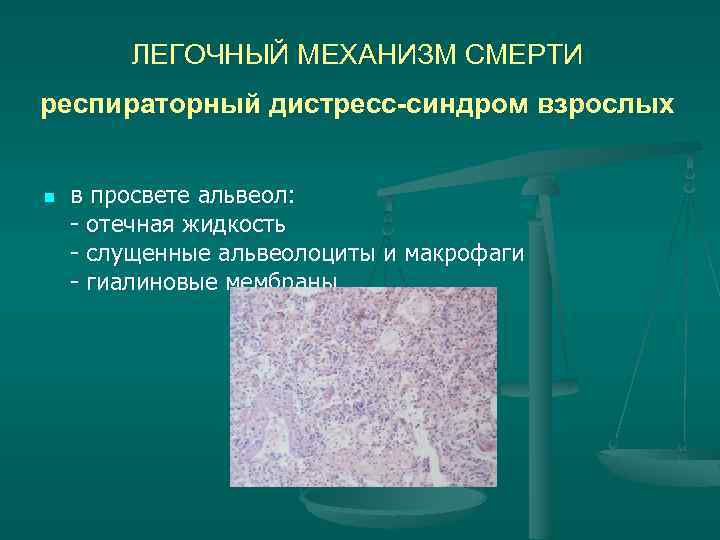 ЛЕГОЧНЫЙ МЕХАНИЗМ СМЕРТИ респираторный дистресс-синдром взрослых n в просвете альвеол: - отечная жидкость -