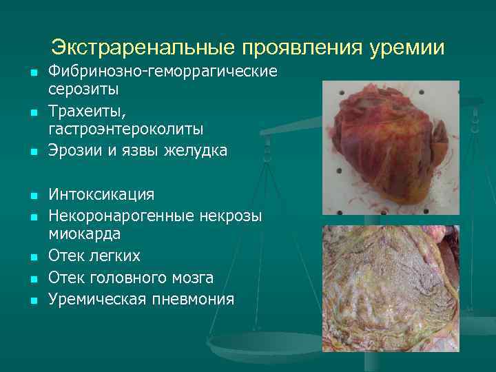 Экстраренальные проявления уремии n n n n Фибринозно-геморрагические серозиты Трахеиты, гастроэнтероколиты Эрозии и язвы