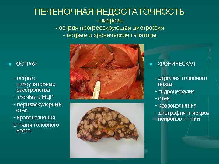 ПЕЧЕНОЧНАЯ НЕДОСТАТОЧНОСТЬ - циррозы - острая прогрессирующая дистрофия - острые и хронические гепатиты n