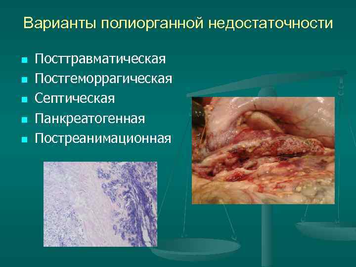 Варианты полиорганной недостаточности n n n Посттравматическая Постгеморрагическая Септическая Панкреатогенная Постреанимационная 