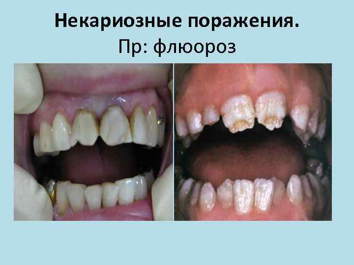 Некариозные поражения. Пр: флюороз 