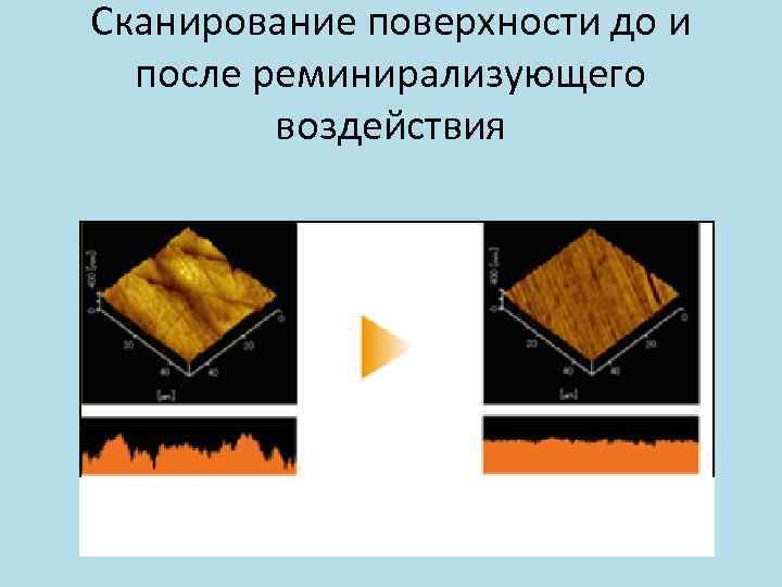 Сканирование поверхности до и после реминирализующего воздействия 