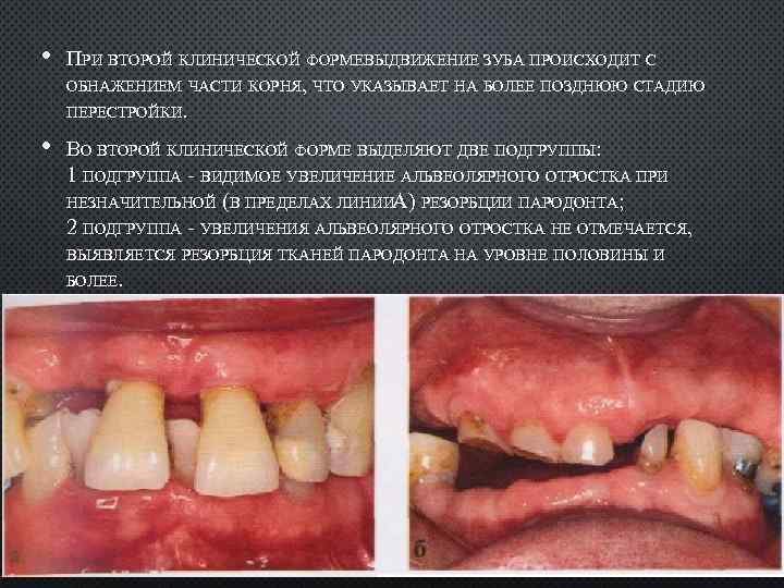  • ПРИ ВТОРОЙ КЛИНИЧЕСКОЙ ФОРМЕВЫДВИЖЕНИЕ ЗУБА ПРОИСХОДИТ С ОБНАЖЕНИЕМ ЧАСТИ КОРНЯ, ЧТО УКАЗЫВАЕТ