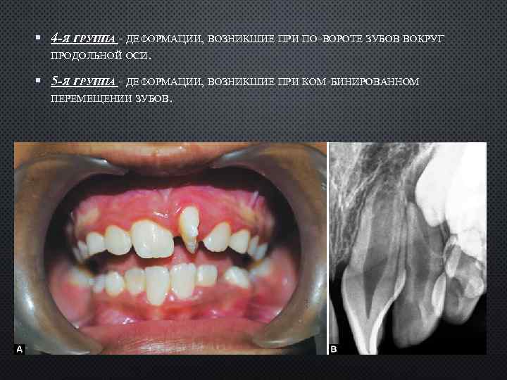  4 -Я ГРУППА ДЕФОРМАЦИИ, ВОЗНИКШИЕ ПРИ ПО ВОРОТЕ ЗУБОВ ВОКРУГ ПРОДОЛЬНОЙ ОСИ. 5