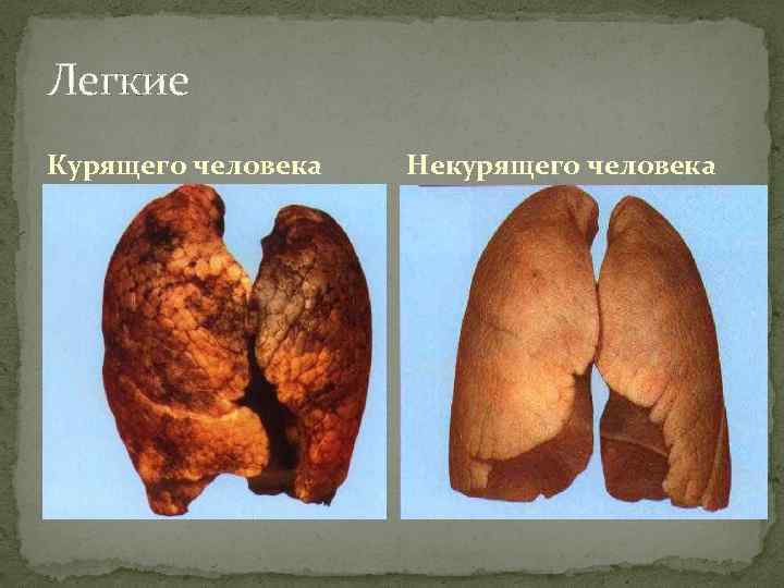 Легкие Курящего человека Некурящего человека 