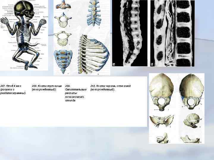207. Плод 4 мес (рисунок с рентгенограммы). 208. Кости туловища (новорожденный). 209. Сагиттальные распилы
