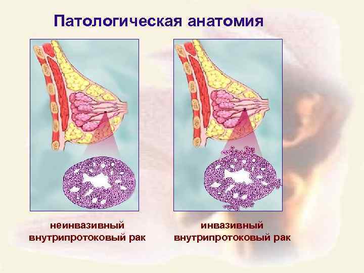 Патологическая анатомия неинвазивный внутрипротоковый рак 