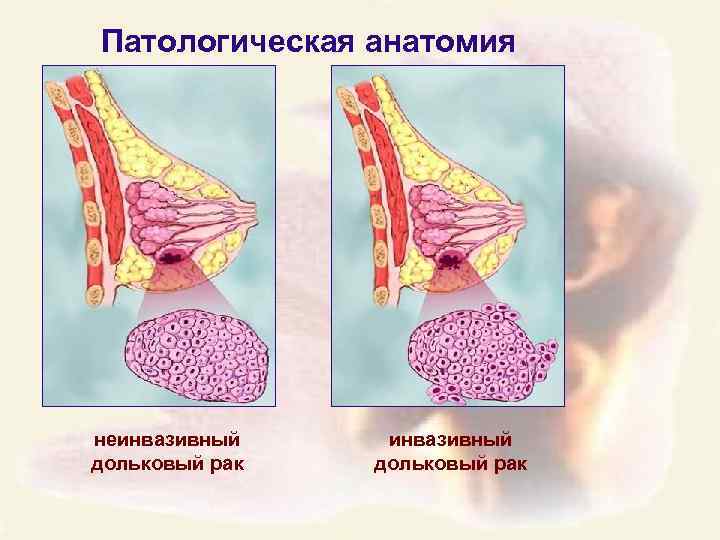 Патологическая анатомия неинвазивный дольковый рак 