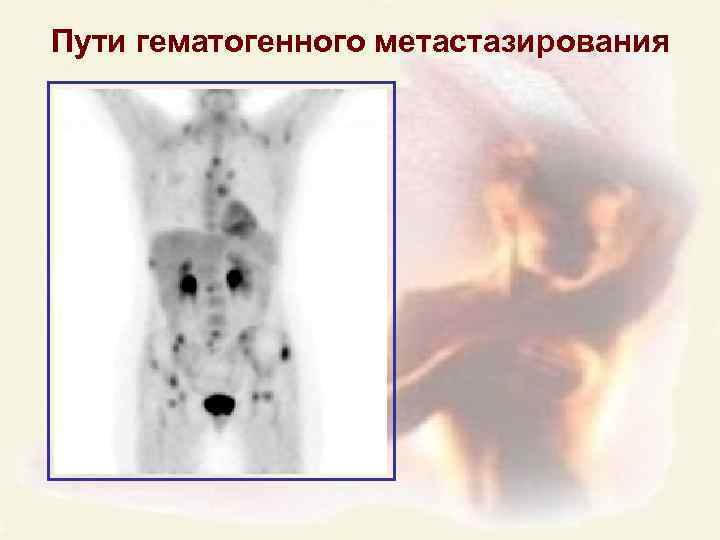 Пути гематогенного метастазирования 