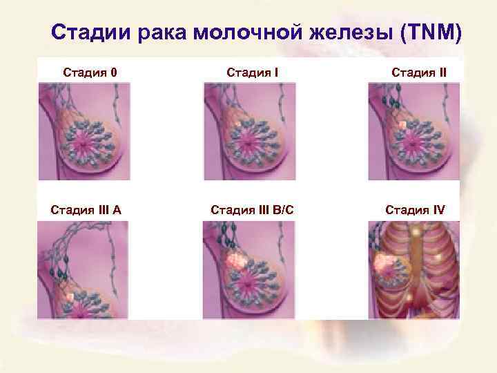 Стадии рака молочной железы (TNM) Стадия 0 Стадия III A Стадия III B/C Стадия