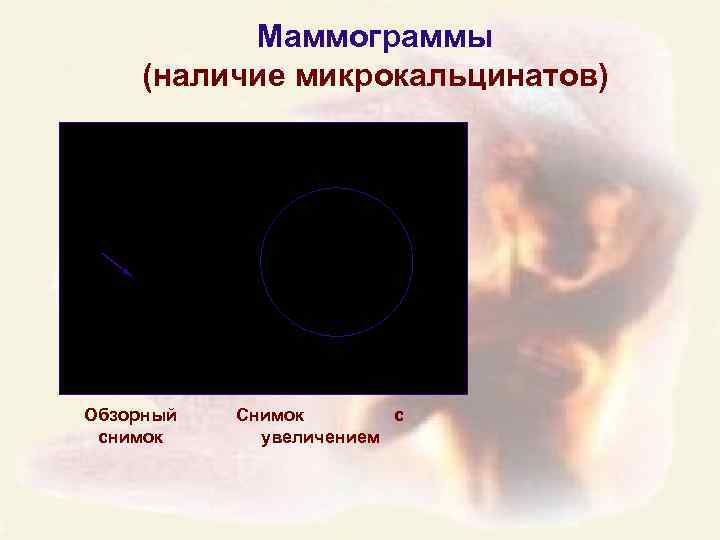 Маммограммы (наличие микрокальцинатов) Обзорный снимок Снимок с увеличением 