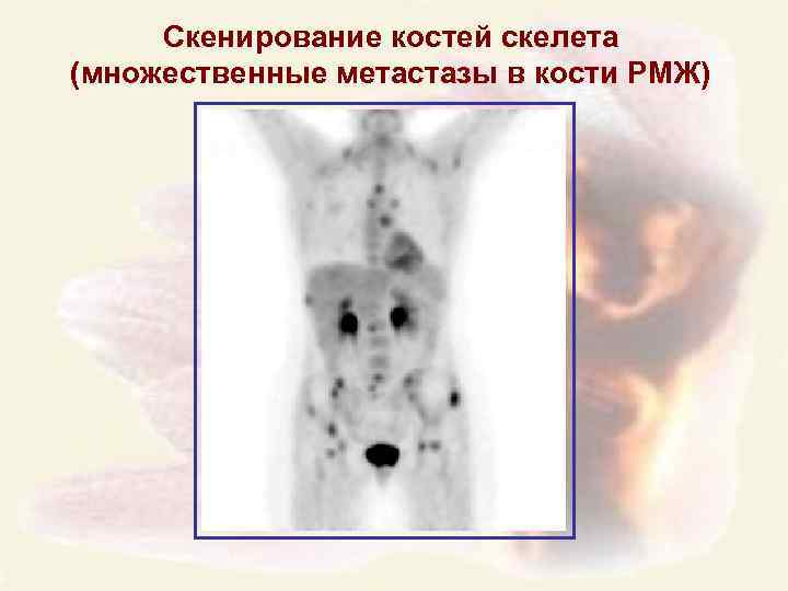 Скенирование костей скелета (множественные метастазы в кости РМЖ) 