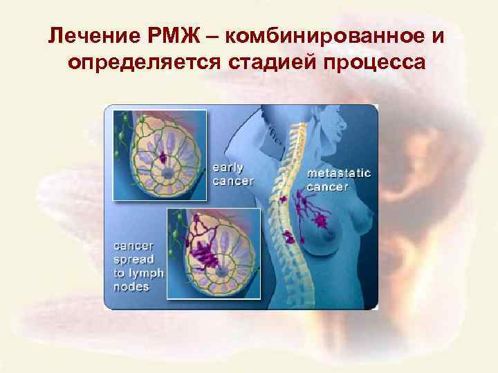 Лечение РМЖ – комбинированное и определяется стадией процесса 