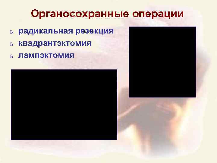 Органосохранные операции ь радикальная резекция ь квадрантэктомия ь лампэктомия 