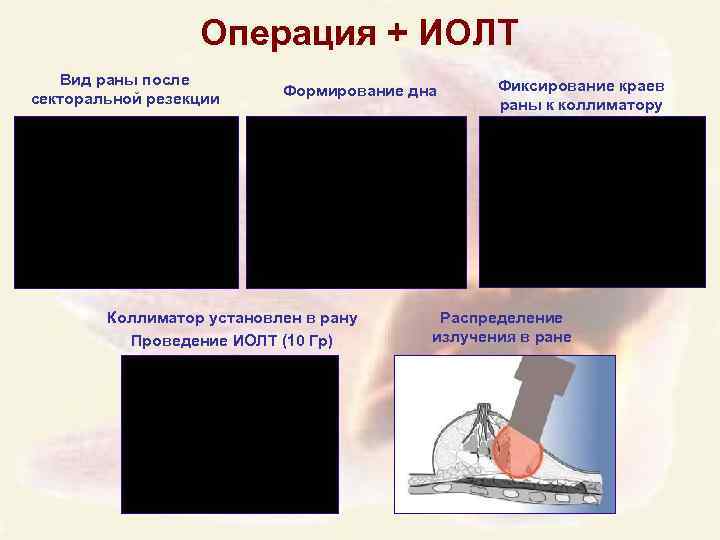 Операция + ИОЛТ Вид раны после секторальной резекции Формирование дна Коллиматор установлен в рану