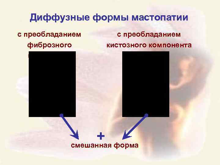 Диффузные формы мастопатии с преобладанием фиброзного компонента с преобладанием кистозного компонента + форма смешанная