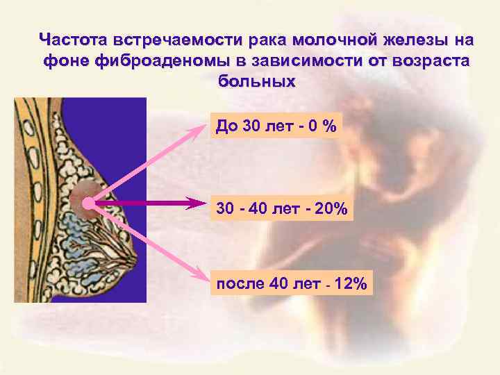 Частота встречаемости рака молочной железы на фоне фиброаденомы в зависимости от возраста больных До