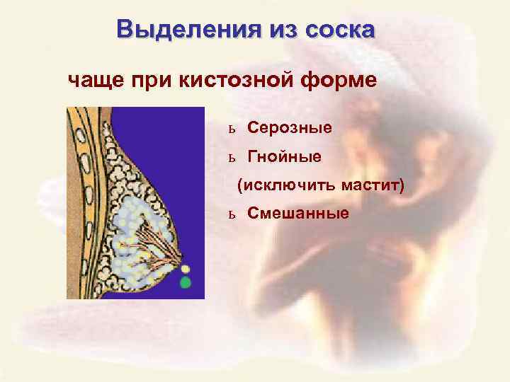 Выделения из соска чаще при кистозной форме ь Серозные ь Гнойные (исключить мастит) ь