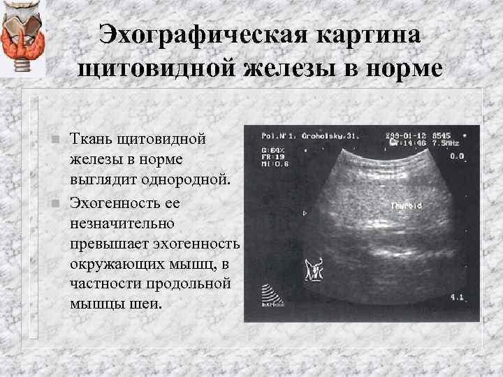 Эхографическая картина щитовидной железы в норме n n Ткань щитовидной железы в норме выглядит